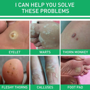Active Corn Remover Gel