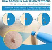 Auto Skin Tag Remover