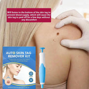 Auto Skin Tag Remover